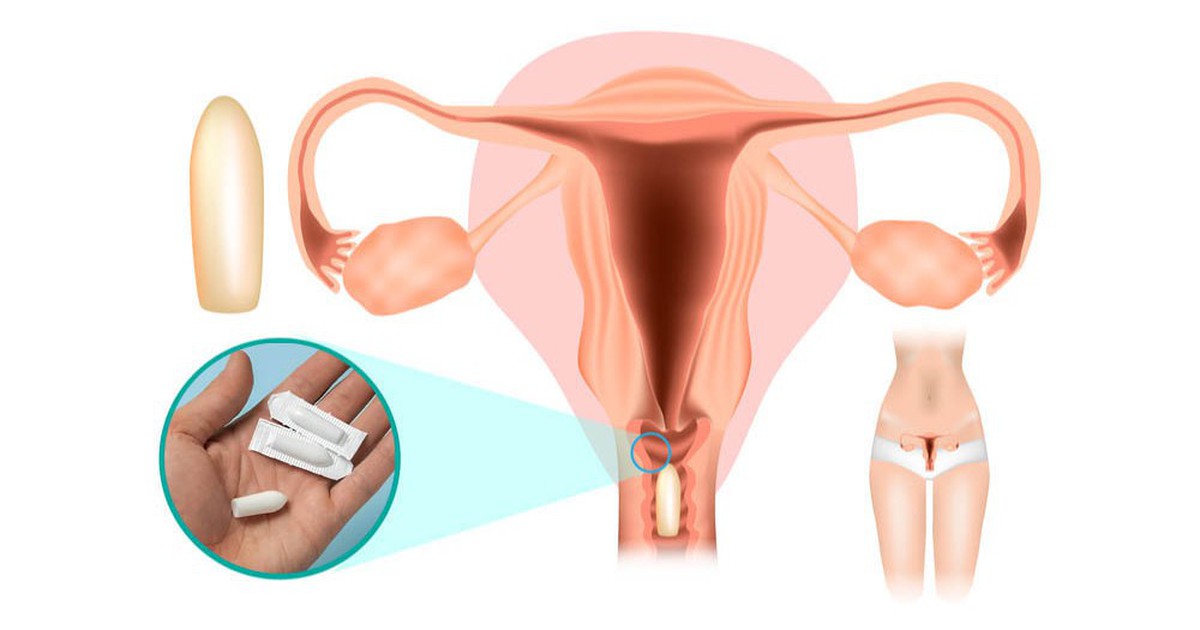 Vùng kín ngứa ngáy, đừng vội đặt thuốc nếu chưa biết điều này