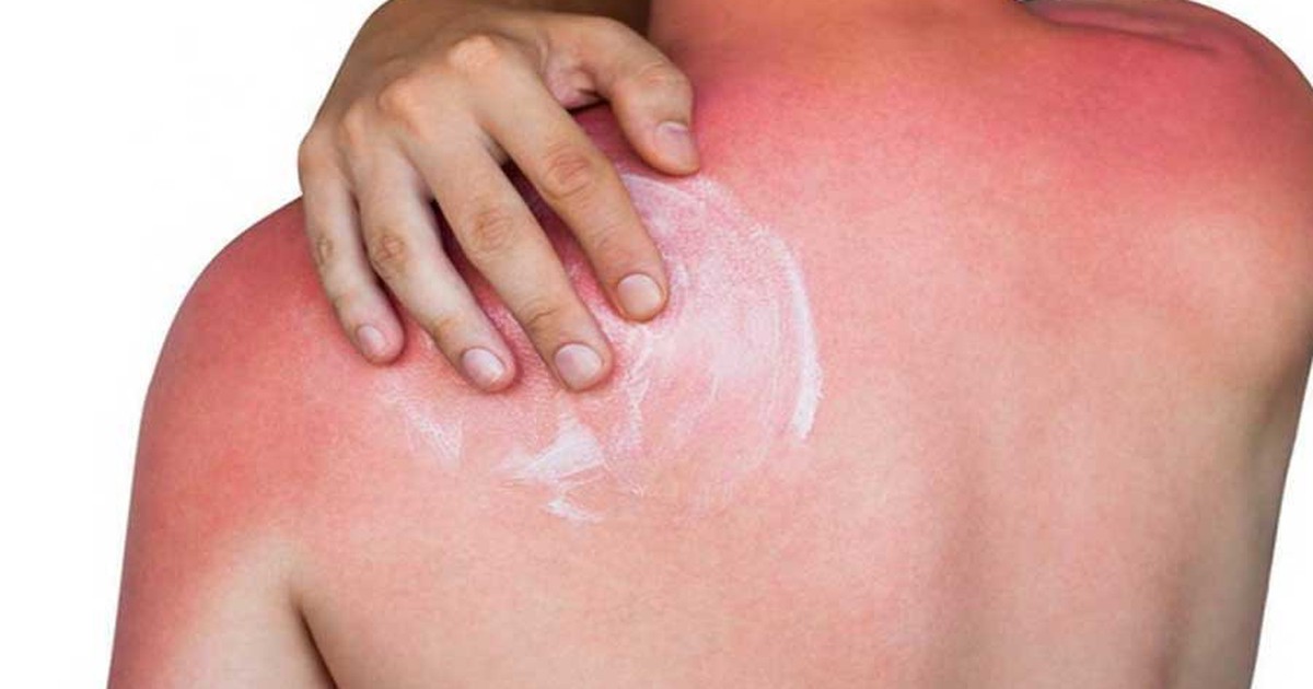 Trào lưu phơi nắng "trị bách bệnh" có nguy cơ ung thư da