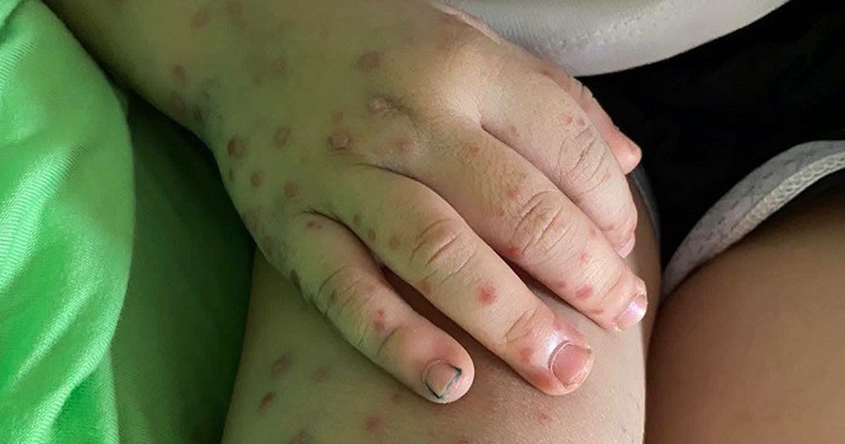 Ghi nhận hơn 1.800 ca tay chân miệng trong 1 tuần: Cảnh giác dấu hiệu bệnh chuyển nặng