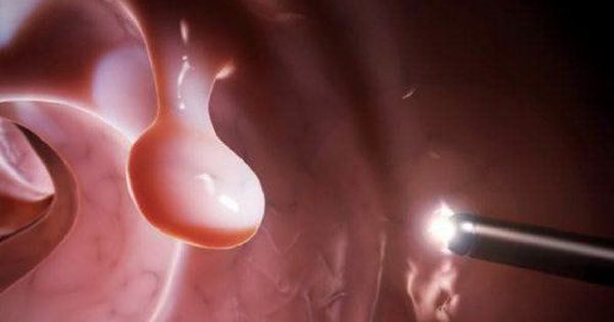 Đa polyp túi mật có nguy hiểm không?