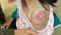 Những vết thương chi chít trên cơ thể của cô bé bị bạo hành
