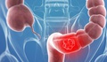 Sàng lọc phát hiện sớm ung thư đại tràng