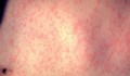 Số ca mắc bệnh sởi tại châu Mỹ tăng mạnh