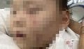Đón con từ nhà trẻ về có nhiều vết bầm tím trên người: Tạm giữ bảo mẫu để điều tra