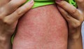 Mỹ: Bang New York ban bố tình trạng khẩn cấp do bệnh sởi
