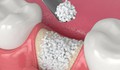 Nghiên cứu phát triển vật liệu ghép xương giá rẻ từ xương bò