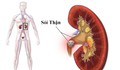 Nhập viện vì sỏi thận, chuyên gia khuyến cáo cần phát hiện sớm khi có biểu hiện này