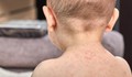 Mỹ đối mặt nguy cơ bùng phát dịch sởi tồi tệ nhất sau 35 năm