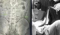 Nhét lươn sống dài nửa mét vào hậu môn, người đàn ông suýt thủng ruột