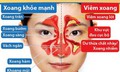 Thực dưỡng cho người bệnh vi&#234;m xoang