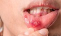 Vết thương hở v&#224; nguy cơ l&#226;y truyền HIV: Hiểu r&#245; để ph&#242;ng ngừa hiệu quả