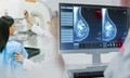 Ph&#225;t hiện sớm ung thư v&#250; nhờ ứng dụng AI trong chụp nhũ ảnh tầm so&#225;t