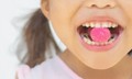 7 loại thực phẩm l&#224;m tăng nguy cơ s&#226;u răng bạn n&#234;n biết để tr&#225;nh