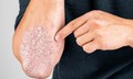 Bệnh vảy nến: dấu hiệu nhận biết v&#224; những ai c&#243; nguy cơ cao?