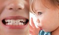 Điều trị sớm khớp cắn ngược răng sữa ở trẻ