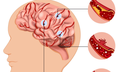 Bệnh nhân 87 tuổi hôn mê sâu do xuất huyết não, cảnh báo nguy cơ và cách phòng ngừa căn bệnh nguy hiểm