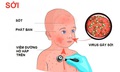 Tự &#253; d&#249;ng kh&#225;ng sinh khi mắc sởi c&#243; thể l&#224;m bệnh nặng hơn