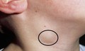 C&#226;u hỏi thường gặp về lao hạch