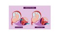 C&#226;u hỏi thường gặp li&#234;n quan đến bệnh hở eo tử cung