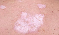 Lichen xơ h&#243;a: Nguy&#234;n nh&#226;n, biểu hiện, c&#225;ch điều trị v&#224; ph&#242;ng bệnh