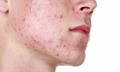C&#225;ch trị mụn trứng c&#225; hiệu quả nhất