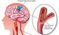 C&#226;u hỏi thường gặp về bệnh xơ vữa động mạch n&#227;o