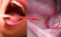 Dấu hiệu điển h&#236;nh của ung thư khoang miệng ở giai đoạn sớm