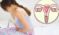 5 dấu hiệu nghi ngờ ung thư cổ tử cung chị em cần biết