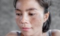 7 vấn đề về da m&#249;a h&#232; c&#243; thể ngăn ngừa