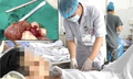 Một thanh ni&#234;n bị xương c&#225; đ&#226;m thủng ruột non, g&#226;y &#225;p xe ổ bụng