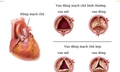 Biến chứng nguy hiểm hẹp van động mạch chủ v&#224; c&#225;ch điều trị