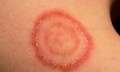 Nấm da: Biểu hiện thường gặp v&#224; sai lầm trong điều trị