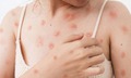 Cảnh báo thủy đậu ở người lớn có thể gây biến chứng nguy hiểm