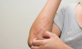 Viêm da dị ứng kiêng gì?