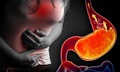 Biến chứng nguy hiểm của bệnh trào ngược dạ dày thực quản