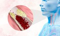 Hẹp động mạch cảnh có thể âm thầm báo trước một cơn đột quỵ