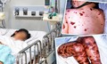TPHCM ghi nhận ca não mô cầu mới tại xã Thường Tân