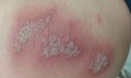 Viêm da tiếp xúc do kiến ba khoang, cách xử trí đúng tránh lan rộng