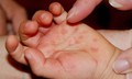 Cách vệ sinh răng miệng và chăm sóc da cho trẻ mắc tay chân miệng tại nhà