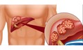 Gan nhiễm mỡ cấp độ mấy phải dùng thuốc kết hợp với ăn kiêng?