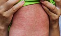 Mỹ: Bang New York ban bố tình trạng khẩn cấp do bệnh sởi