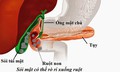 Sỏi túi mật khi nào cần mổ cấp cứu?