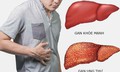 Bí quyết giúp giảm nguy cơ ung thư gan
