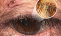 Phát hiện ổ rận mu bám dày trên mí mắt người phụ nữ