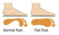 Bàn chân bẹt ở trẻ em có cần điều trị không?