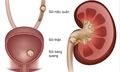 5 nguyên nhân làm tăng nguy cơ sỏi niệu quản và cách phòng ngừa hiệu quả