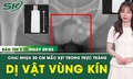 Bản tin Y tế 9/3: Lấy chai nhựa dài khoảng 20cm mắc kẹt sâu trong trực tràng người đàn ông