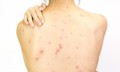 Nguyên nhân mọc mụn trứng cá ở lưng, yếu tố thường gặp nhưng dễ bị bỏ qua