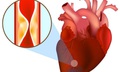 Bỗng dưng bị đau thắt ngực, cảnh giác với nhồi máu cơ tim