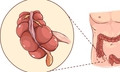 Viêm ruột thừa dễ nhầm lẫn và có thể gây biến chứng gì?